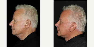 Facelift before and after photo