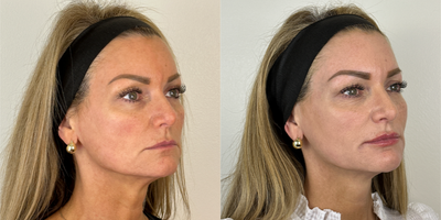 Liquid Facelift before and after photo