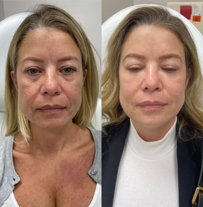 Dermal Fillers before and after photo