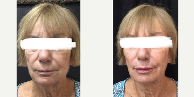 Liquid Facelift before and after photo