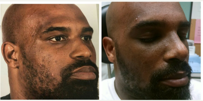 Rhinoplasty before and after photo