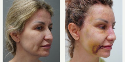 Rhinoplasty before and after photo