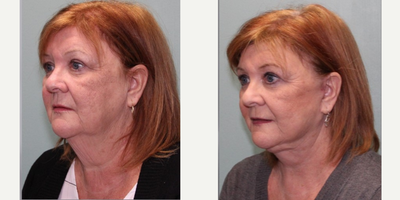 Facelift before and after photo