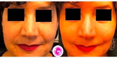 Juvederm before and after photo