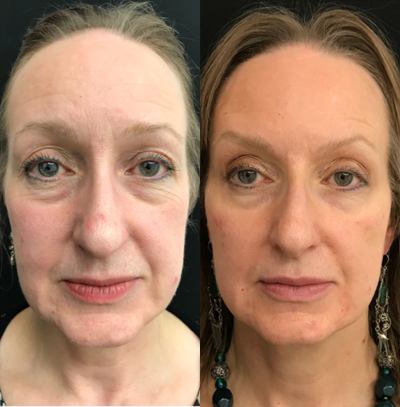 Liquid Facelift before and after photo