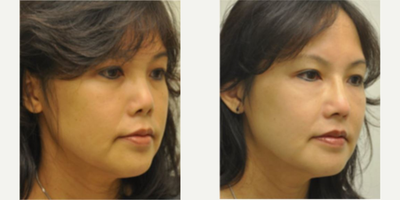 Revision Rhinoplasty before and after photo