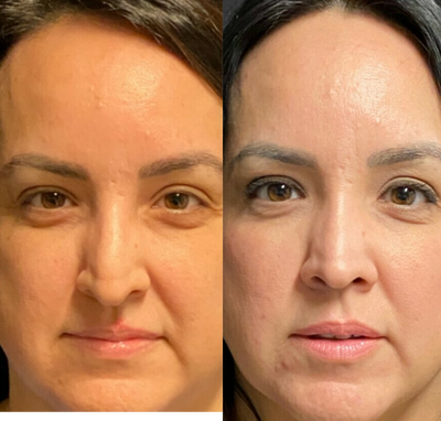 Rhinoplasty before and after photo