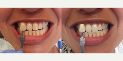 Teeth Whitening before and after photo