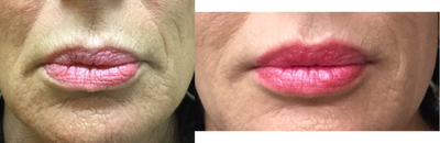Volbella before and after photo
