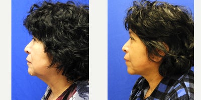 Deep Plane Facelift before and after photo
