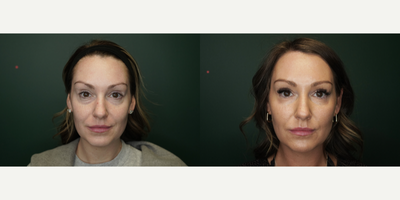 Dermal Fillers before and after photo