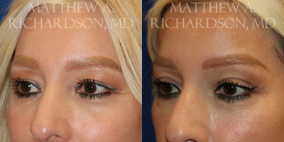 Eyelid Surgery before and after photo