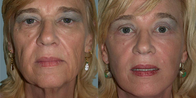 Facelift before and after photo