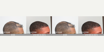 FUE Hair Transplant before and after photo