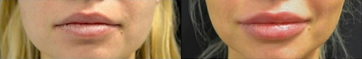 Juvederm before and after photo