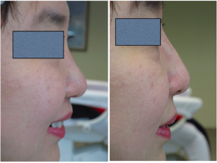 Nonsurgical Nose Job before and after photo