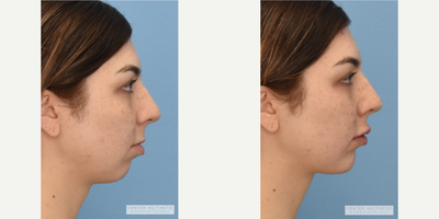 Chin Filler before and after photo