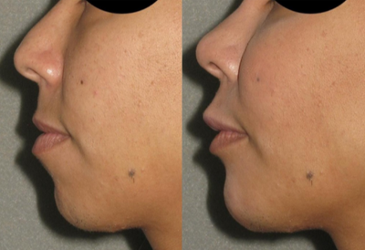 Dermal Fillers before and after photo