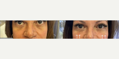 Dermal Fillers before and after photo