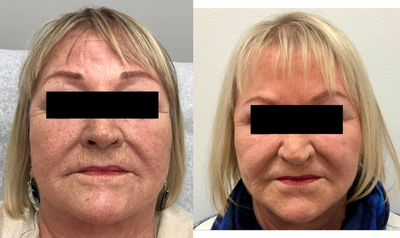IPL before and after photo