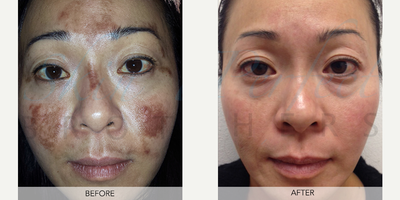 Laser Resurfacing before and after photo