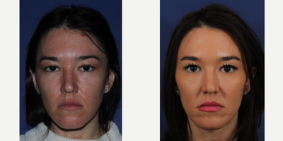 Restylane Lyft before and after photo