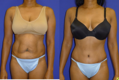Tummy Tuck before and after photo
