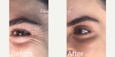 Botox before and after photo