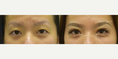 Eyelid Surgery before and after photo