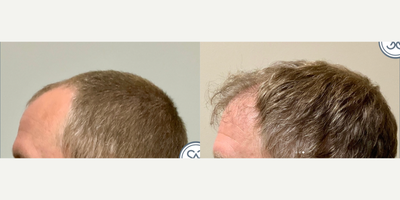 Hair Transplant before and after photo
