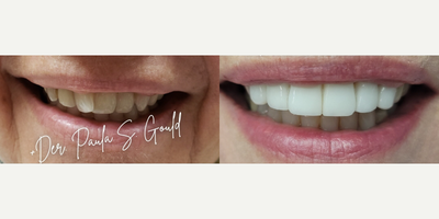 Teeth Whitening before and after photo
