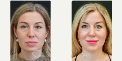 Deep Plane Facelift before and after photo