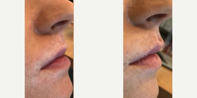 Dermal Fillers before and after photo