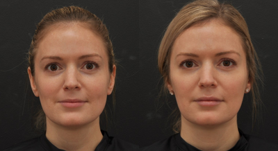 Dermal Fillers before and after photo