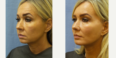 Genioplasty before and after photo