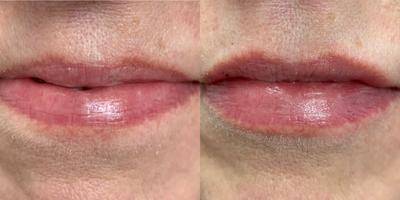 Restylane Silk before and after photo