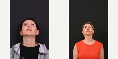 Rhinoplasty before and after photo