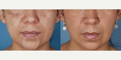 Laser Resurfacing before and after photo