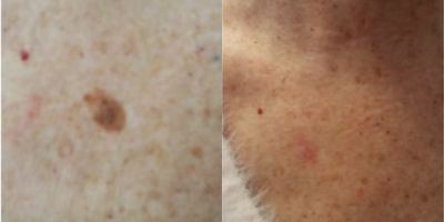 Laser Resurfacing before and after photo