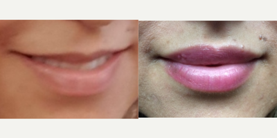 Lip Fillers before and after photo