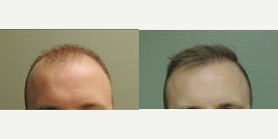 NeoGraft before and after photo