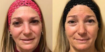 Sculptra before and after photo
