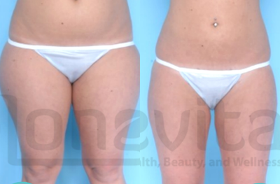Vaser Liposuction before and after photo