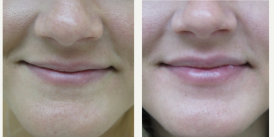 Lip Fillers before and after photo