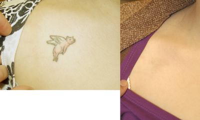 Tattoo Removal before and after photo