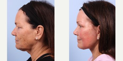 Brow Lift before and after photo