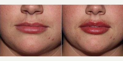 Lip Fillers before and after photo
