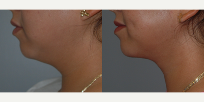 Liposuction before and after photo