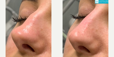 Nonsurgical Nose Job before and after photo