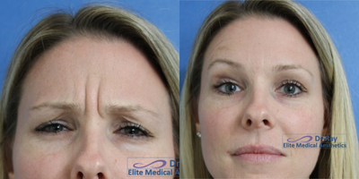 Botox before and after photo